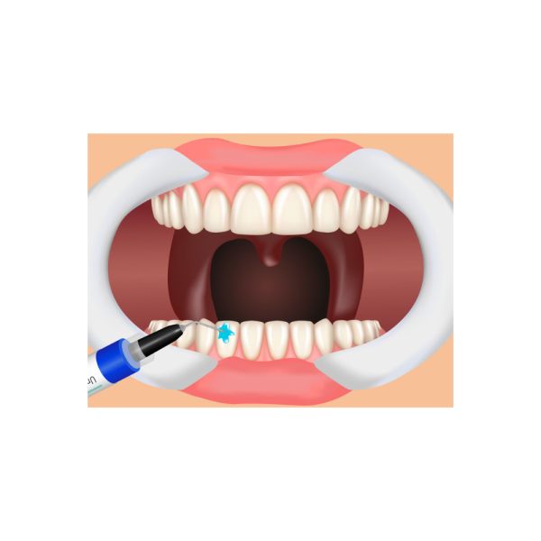 Clarity Attachment Material | Solventum - demo